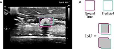 Automatic detection of foreign body objects in neurosurgery using a deep learning approach on intraoperative ultrasound images: From animal models to first in-human testing